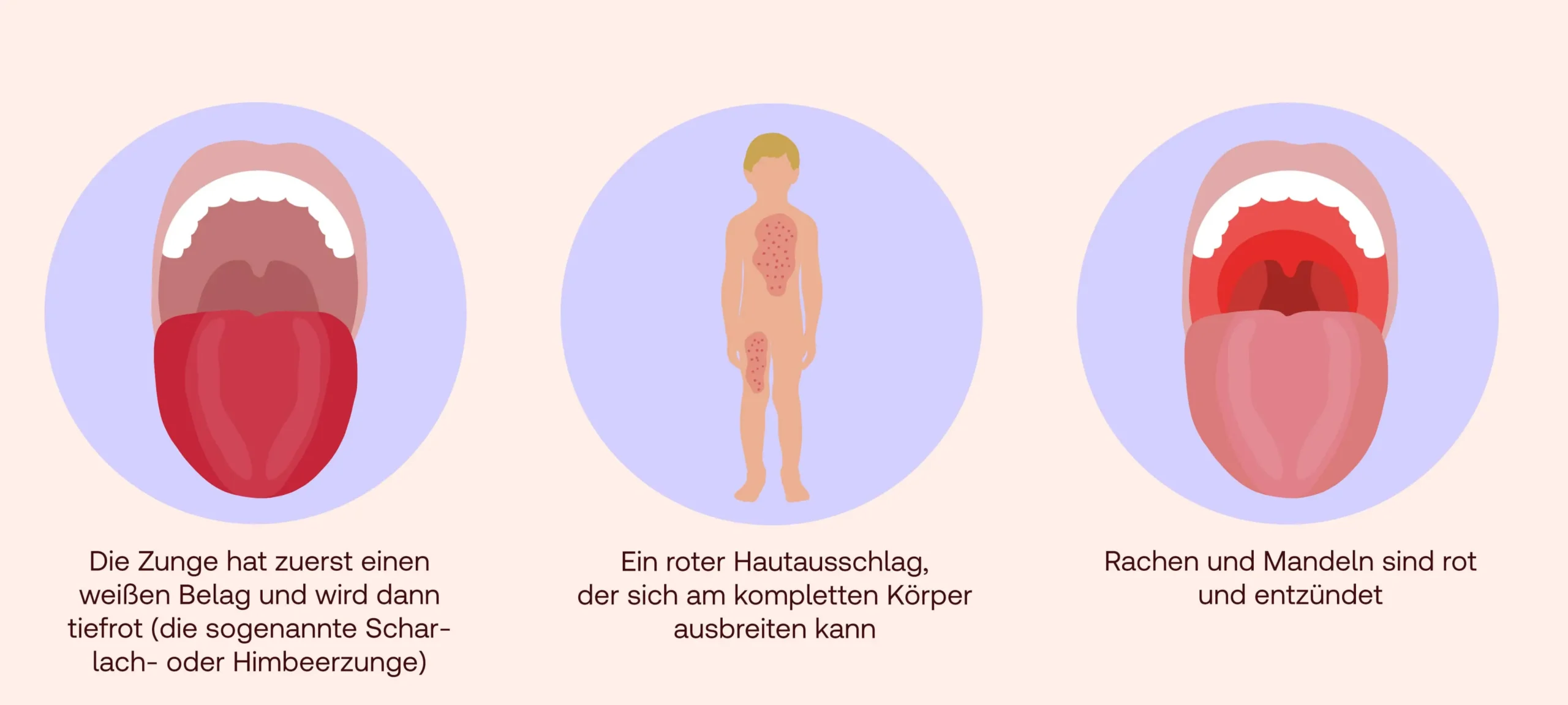scharlach wie lange ansteckend - Wie lange muss ein Kind mit Scharlach zu Hause bleiben