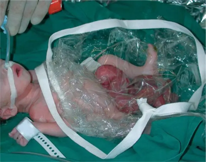 omphalozele überlebenschance - Wie lange physiologische Omphalozele