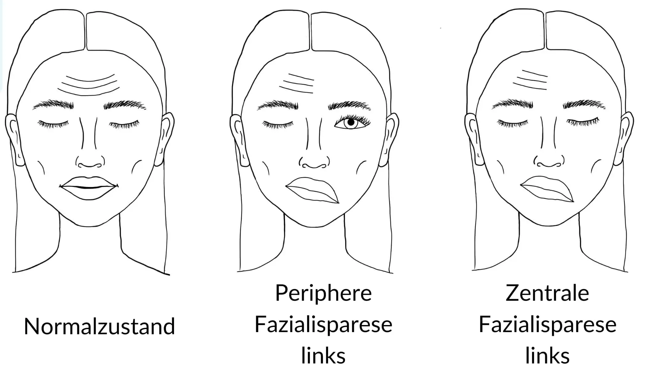 Fazialisparese während der Schwangerschaft: Erfahrungen und Informationen - Wie lange Schmerzen bei Fazialisparese fazialisparese schwangerschaft erfahrungen - Wie lange Schmerzen bei Fazialisparese