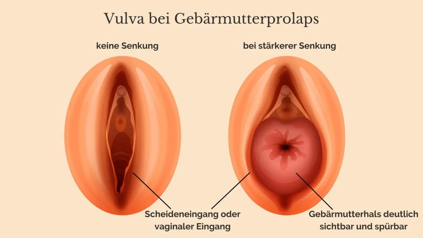 gebärmuttersenkung nach geburt - Wie lange Senkung nach Geburt
