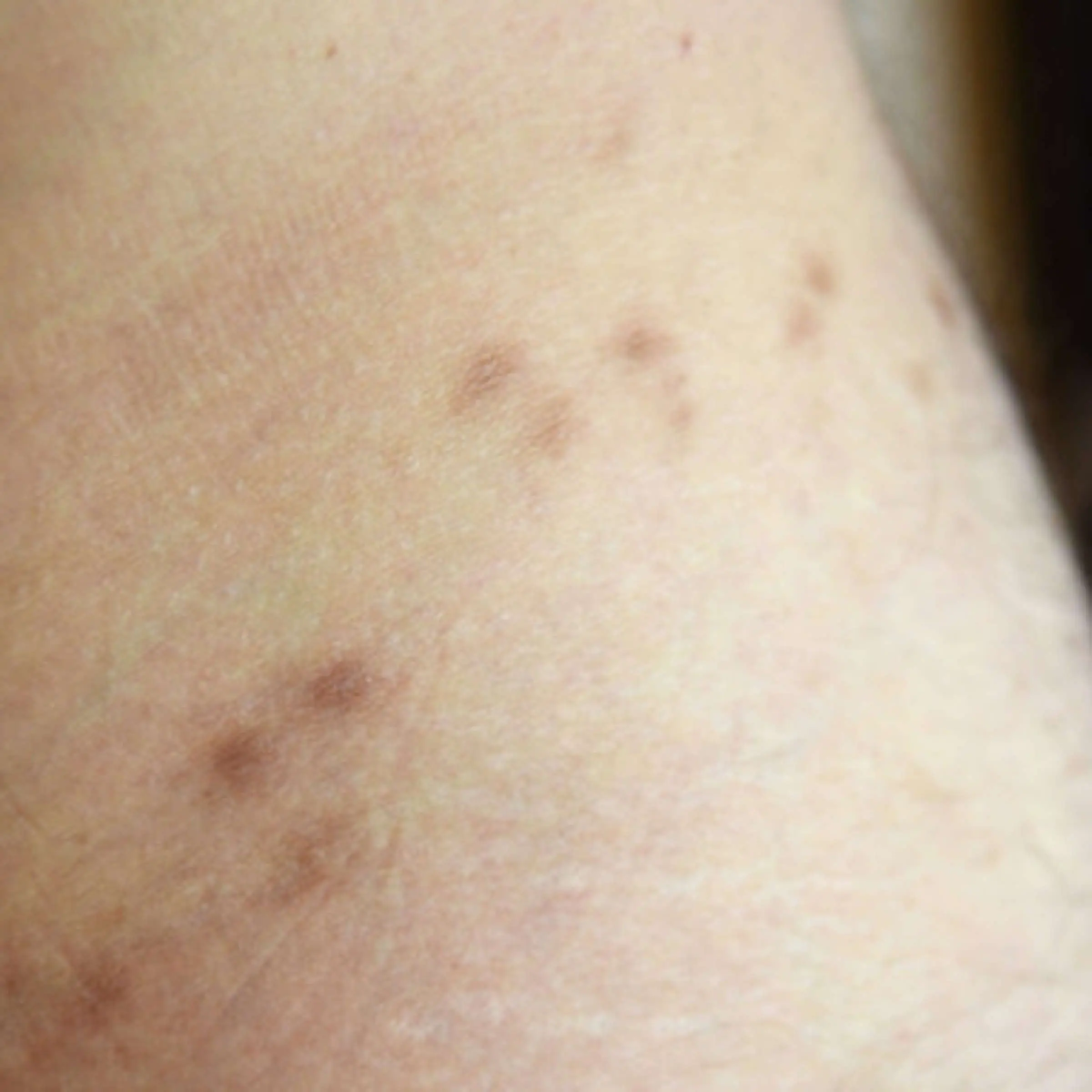 wie lange überlebt krätze in kleidung - Wie lange überlebt Krätze auf Couch