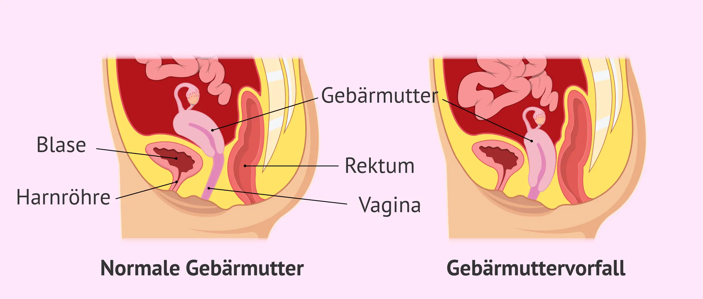 harnverhalt schwangerschaft - Wie lange warten bei Harnverhalt