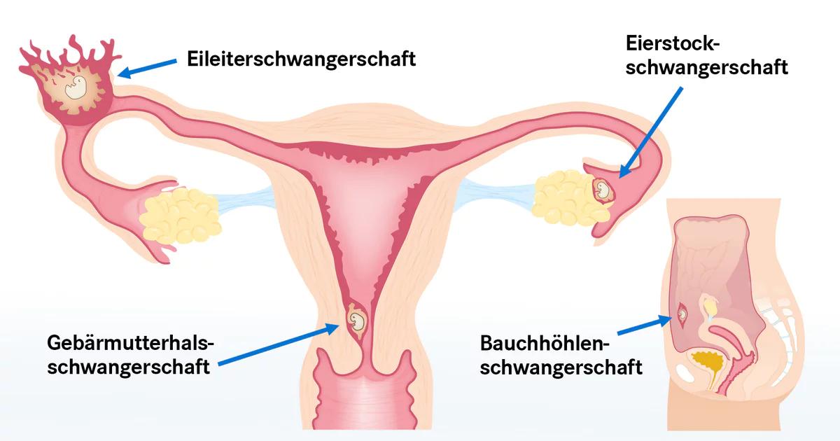 eierstock schwangerschaft op - Wie läuft eine Eileiterschwangerschaft OP ab