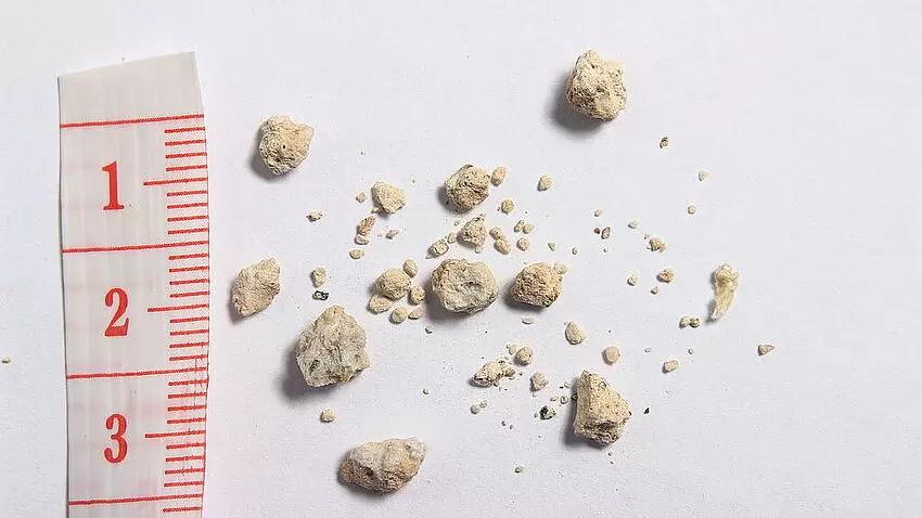 nierenstein-op gefährlich - Wie läuft eine Nierenstein OP ab