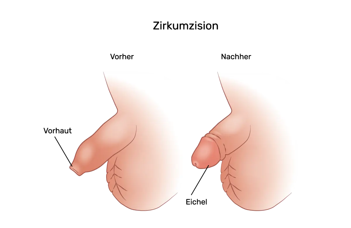 zurückgezogene vorhaut - Wie löst man eine Vorhautverengung