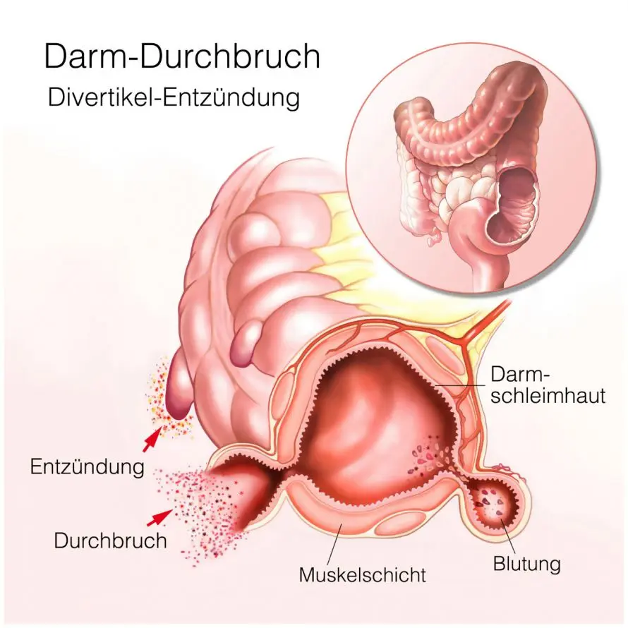 ursachen darminfarkt - Wie machen sich Durchblutungsstörungen im Darm bemerkbar