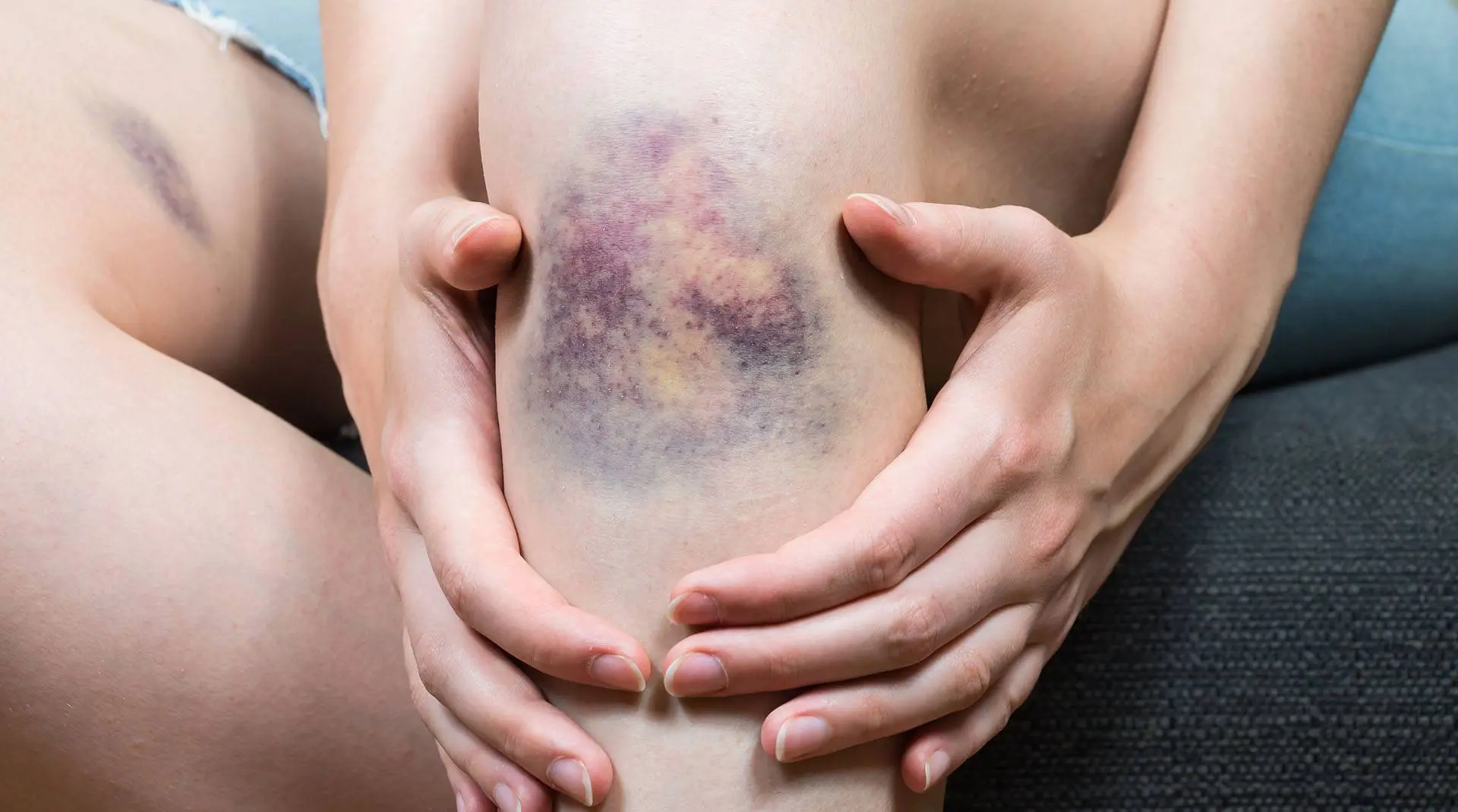 gerinnungsstörung schwangerschaft - Wie macht sich eine Gerinnungsstörung bemerkbar