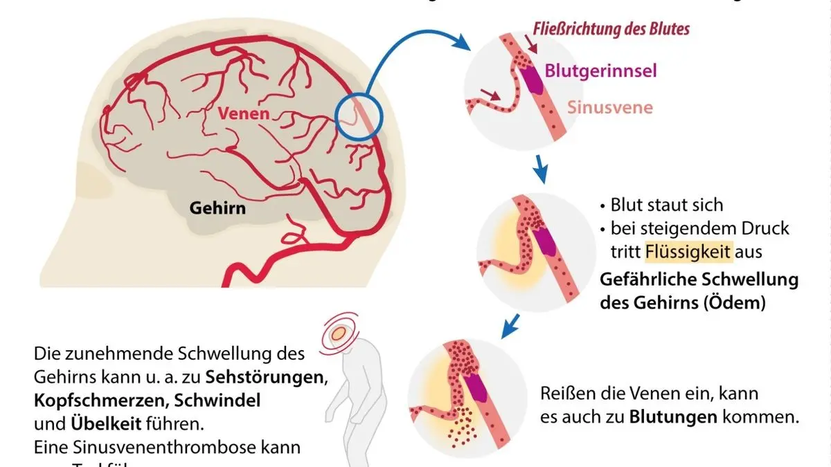 sinusvenenthrombose schwangerschaft - Wie macht sich eine Sinusvenenthrombose bemerkbar