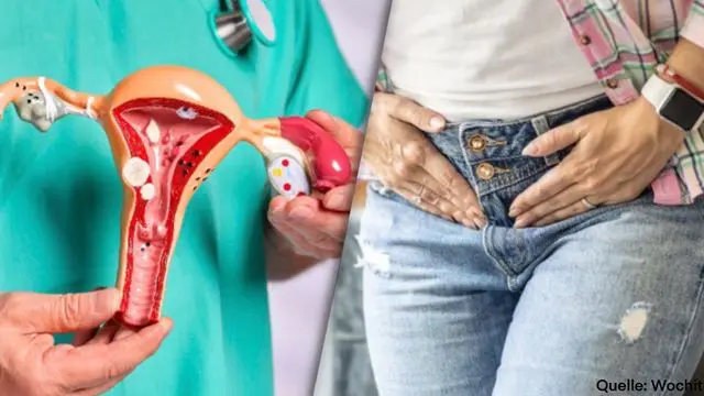 Geplatzte Zyste in der Gebärmutter: Ursachen, Symptome und Behandlung - Wie macht sich eine Zyste in der Gebärmutter bemerkbar geplatzte zyste gebärmutter - Wie macht sich eine Zyste in der Gebärmutter bemerkbar