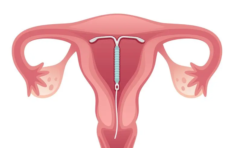 schwangerschaft trotz spirale - Wie merke ich dass ich schwanger bin trotz Spirale