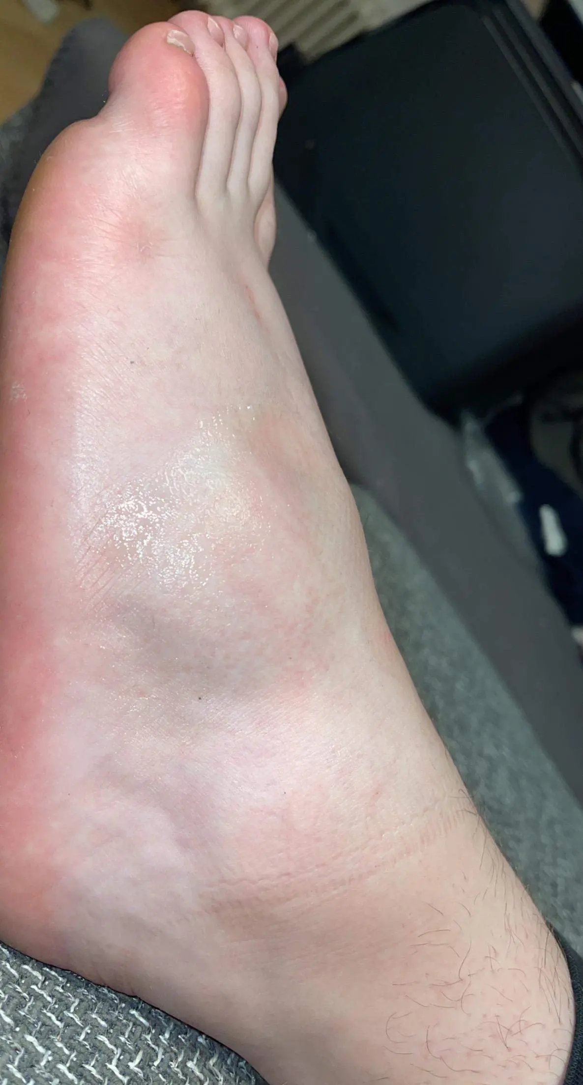 gebrochener fuß symptome - Wie merke ich ob mein Fuß gebrochen ist