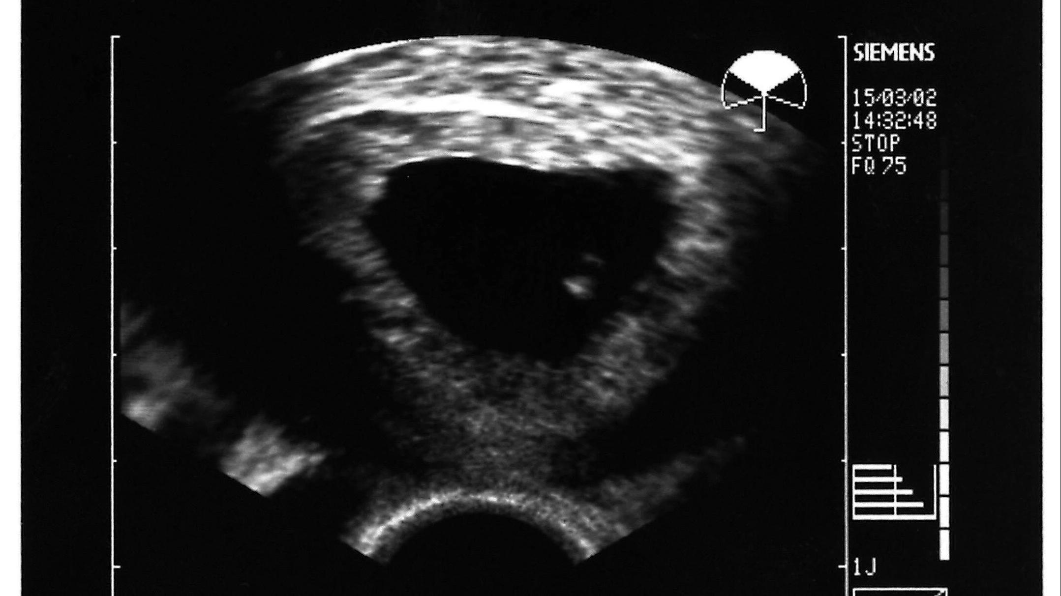 schwangerschaft nicht intakt - Wie merkt man das die Schwangerschaft nicht intakt ist