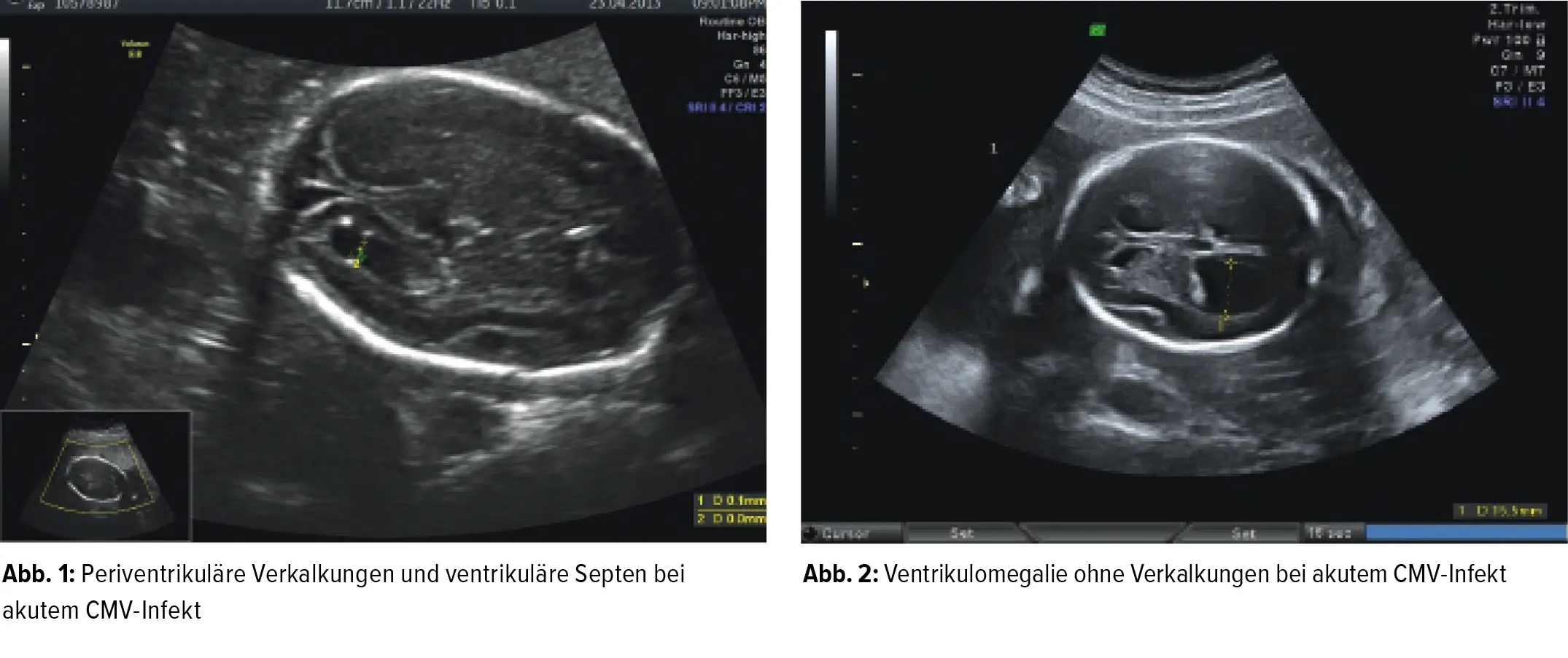 zytomegalie schwangerschaft - Wie merkt man dass man Cytomegalie hat