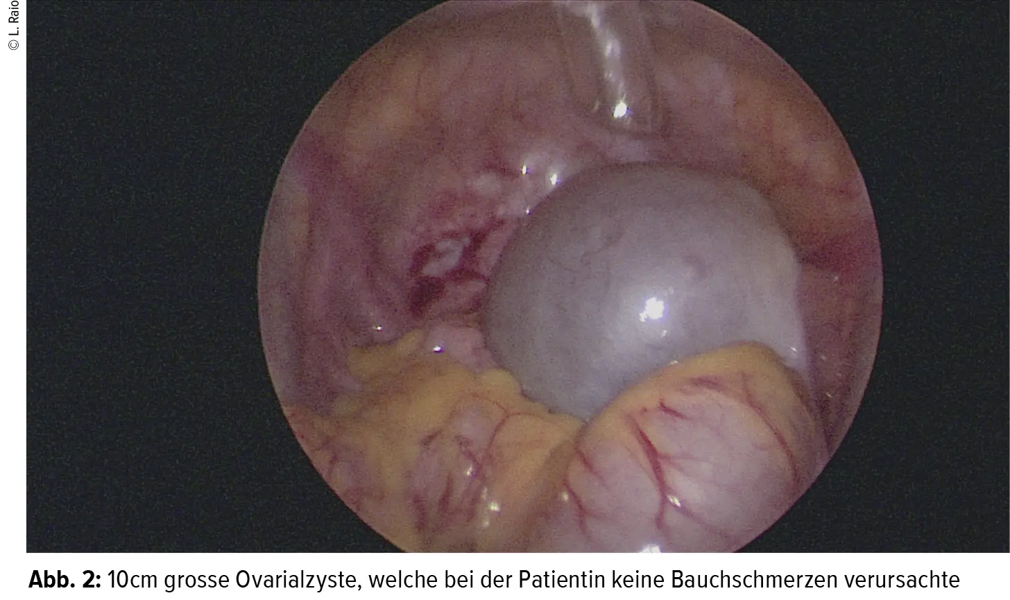 eierstockzyste nach geburt - Wie merkt man dass man eine Zyste am Eierstock hat