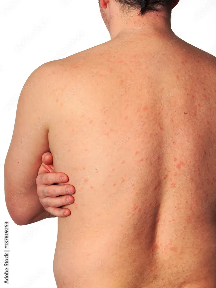 allergischer schock - Wie merkt man dass man einen Schock hat
