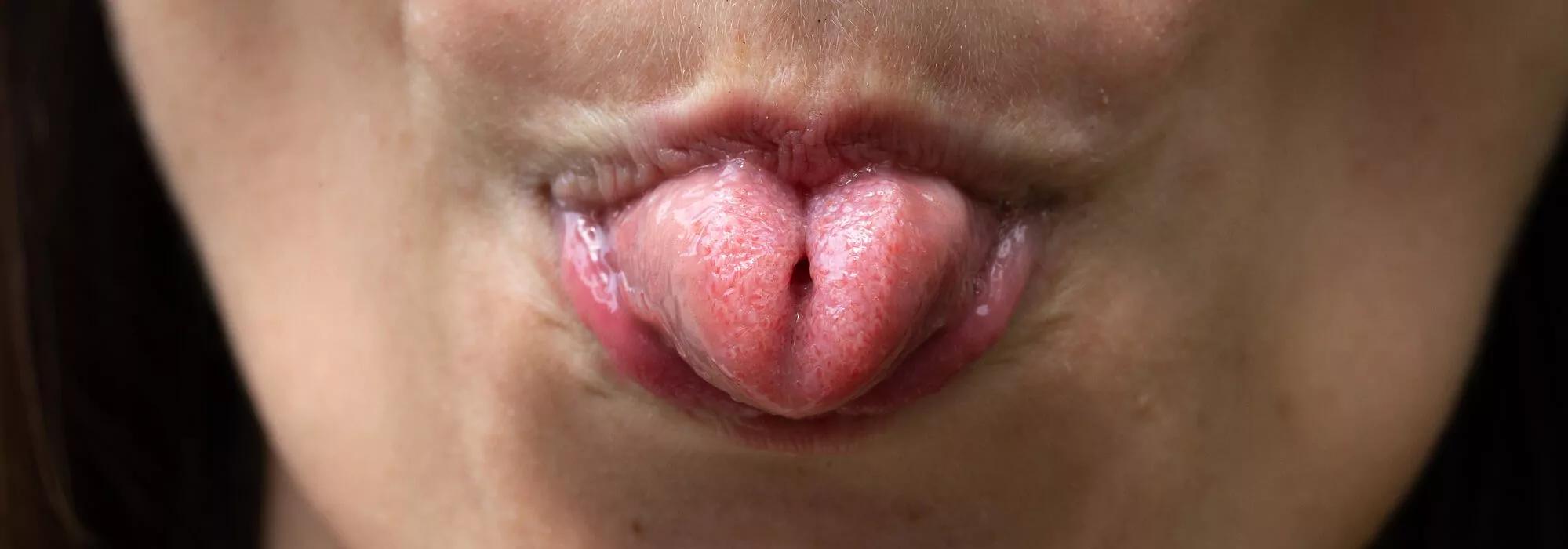 verkürztes zungenbändchen - Wie merkt man ein verkürztes Zungenband