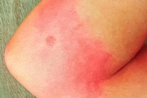 ausschlag nach stich - Wie merkt man eine insektengiftallergie