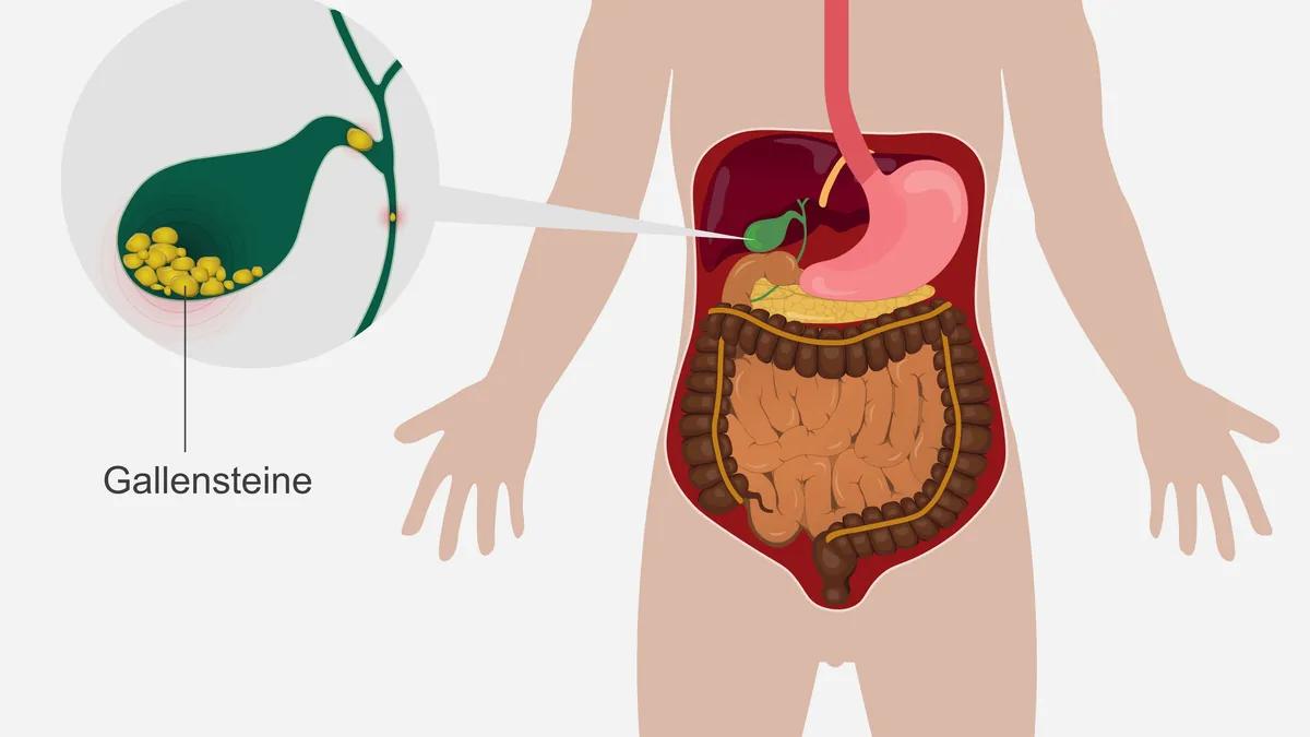 wie machen sich gallensteine bemerkbar - Wie merkt man ob man Gallensteine hat
