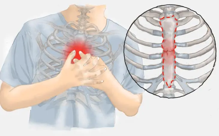 rippenfellentzündung schwangerschaft - Wie merkt man wenn man eine Rippenfellentzündung hat