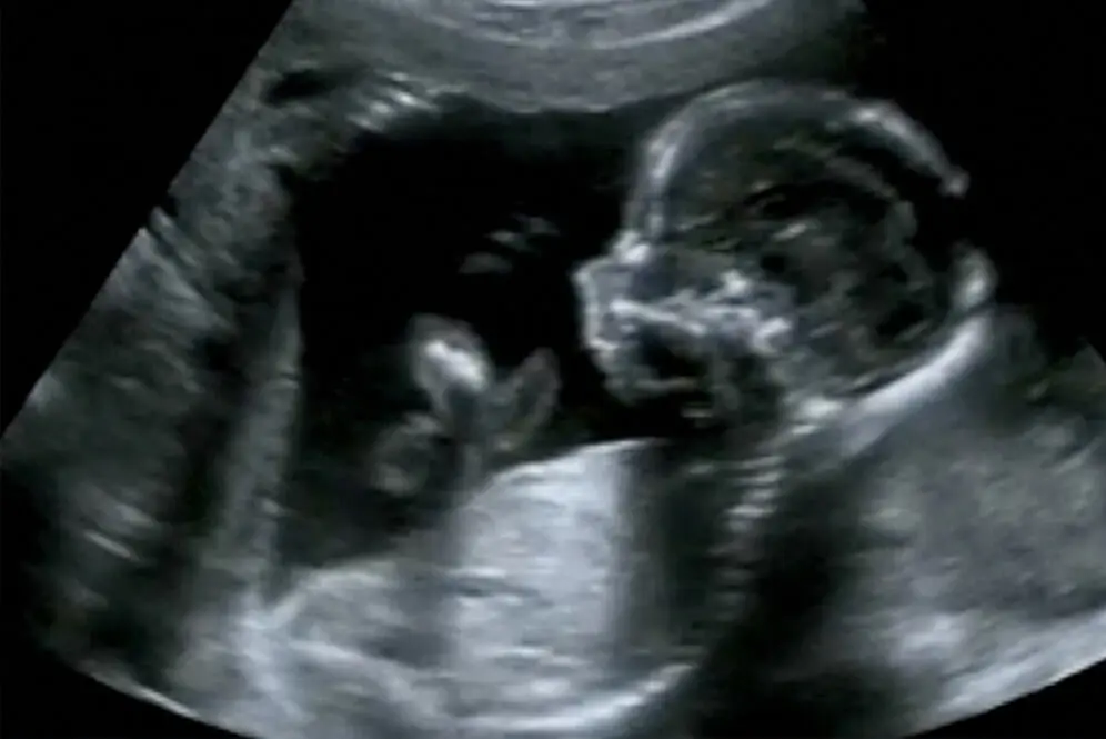 auffällige nackenfaltenmessung - Wie oft ist die Nackenfaltenmessung falsch