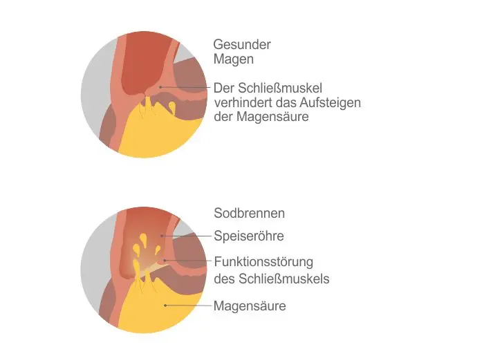 sodbrennen schwangerschaft nachts - Wie schlafen bei Sodbrennen Schwangerschaft