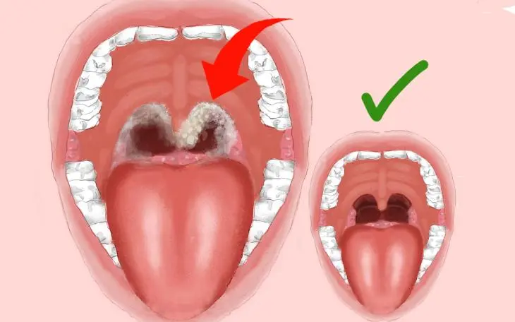 diphtherie-symptome - Wie schlimm ist Diphtherie