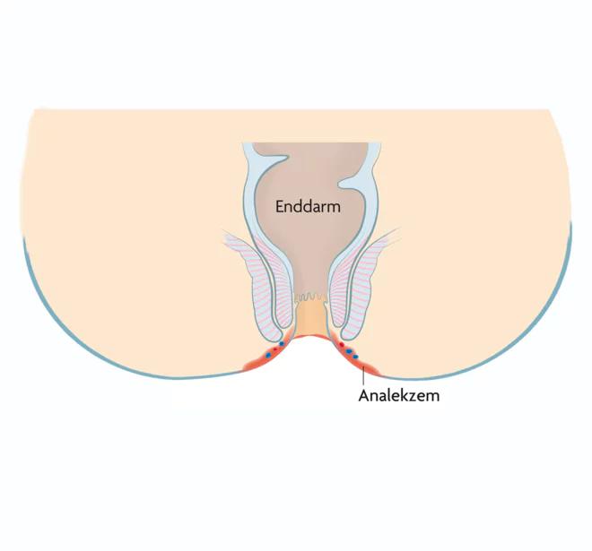 abszess in der schwangerschaft entfernen - Wie schnell muss ein Abszess entfernt werden
