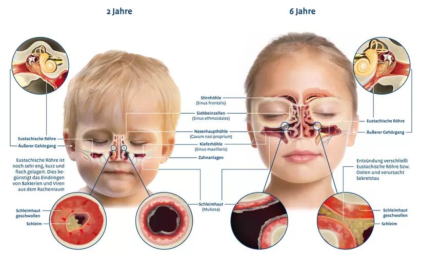 nasenbruch bei kleinkindern - Wie schnell muss ein Nasenbruch behandelt werden
