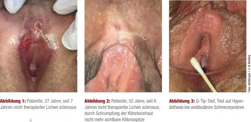 lichen sclerosus geburt - Wie schnell schreitet Lichen sclerosus voran