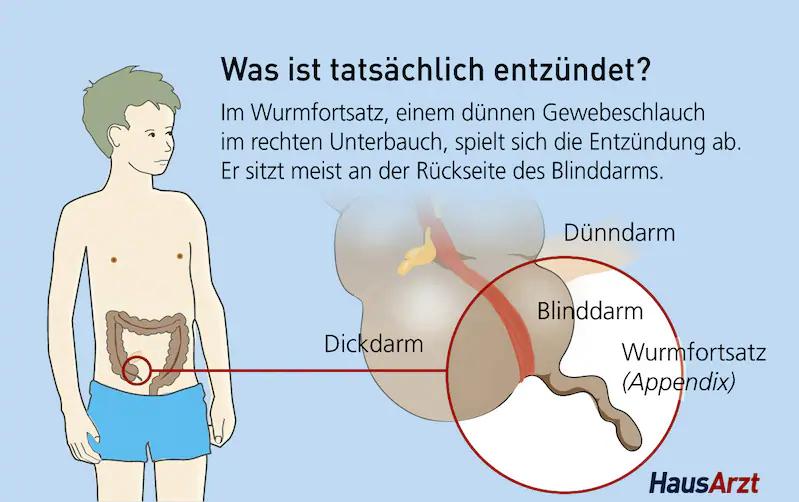 verdacht blinddarm - Wie schnell zum Arzt bei Verdacht auf Blinddarm