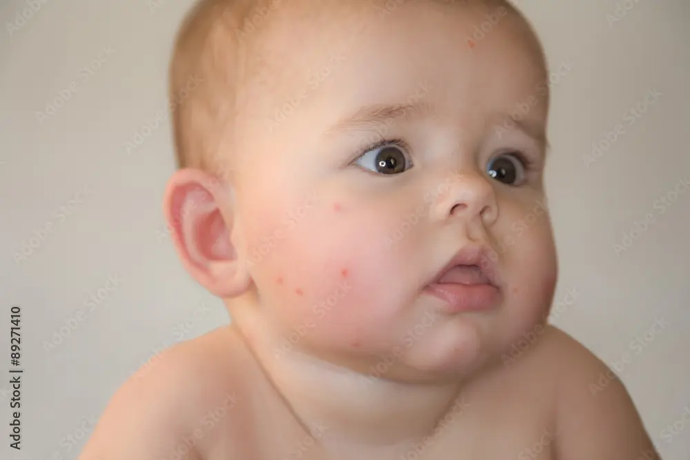 mückenstich babys - Wie schützt man Babys vor Mückenstichen