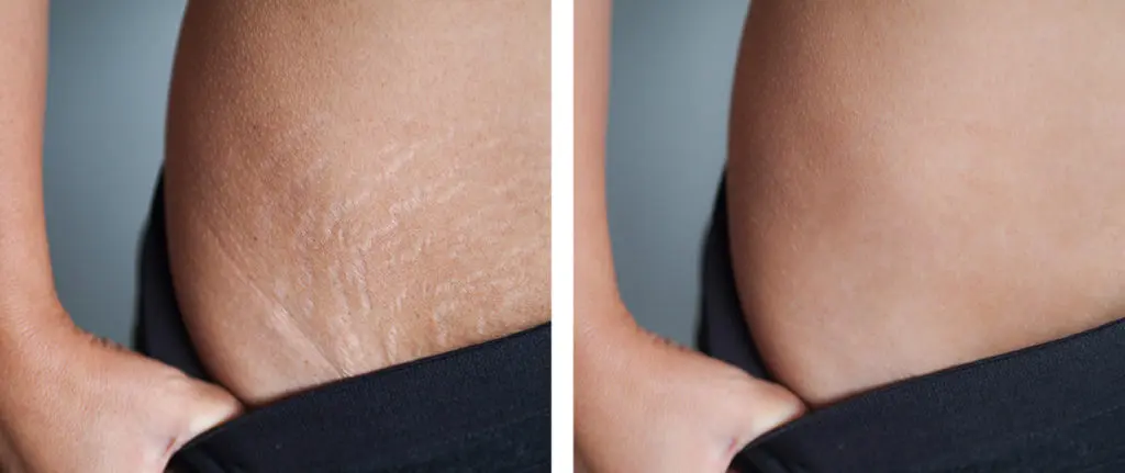 schwangerschaft dehnungsstreifen lasern vorher nachher - Wie sehen Gelaserte Dehnungsstreifen aus