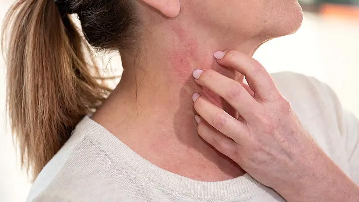 Pusteln am Hals: Ursachen, Symptome und Behandlung - Wie sehen Hitzepickel am Hals aus pusteln am hals - Wie sehen Hitzepickel am Hals aus