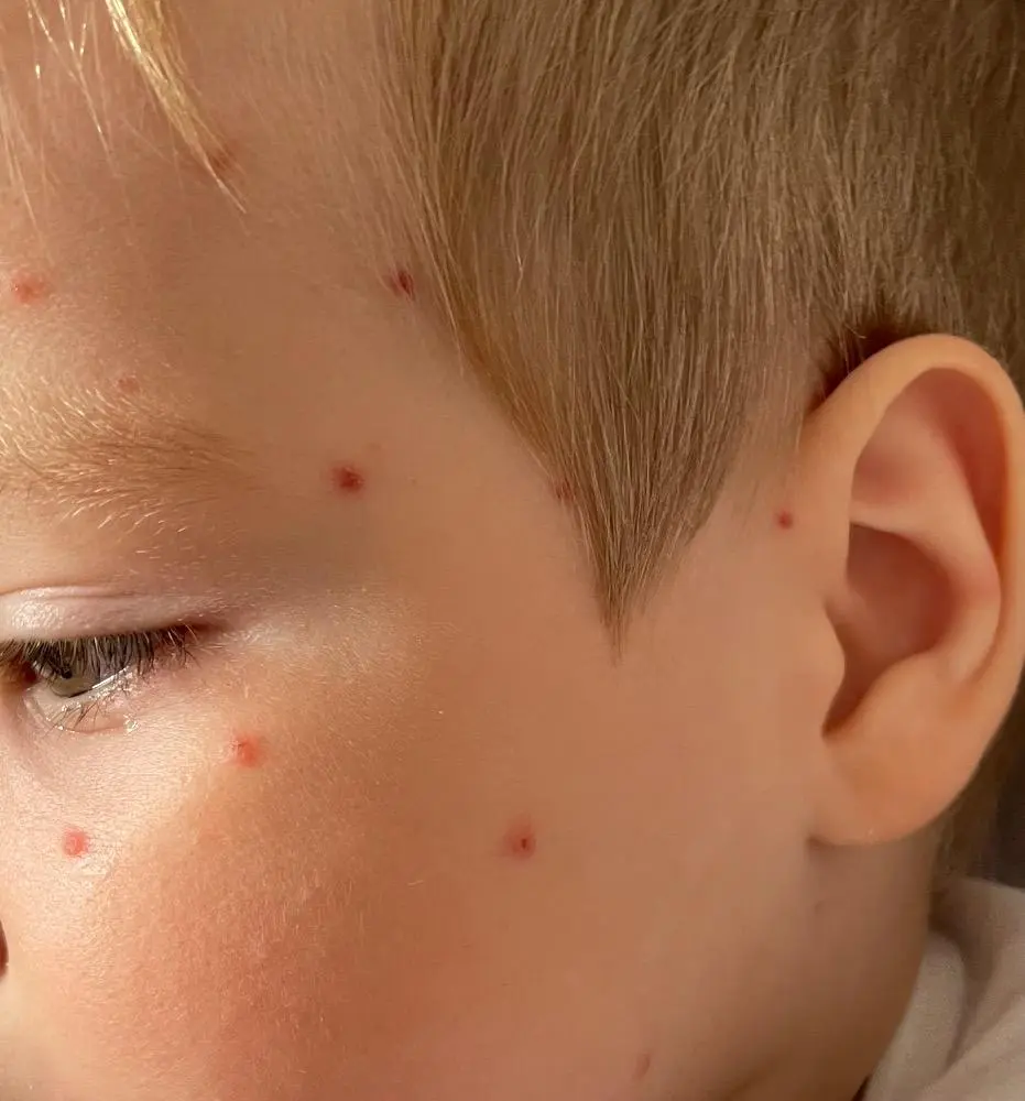 rote punkte bei kleinkindern - Wie sehen Hitzepickel beim Kleinkind aus