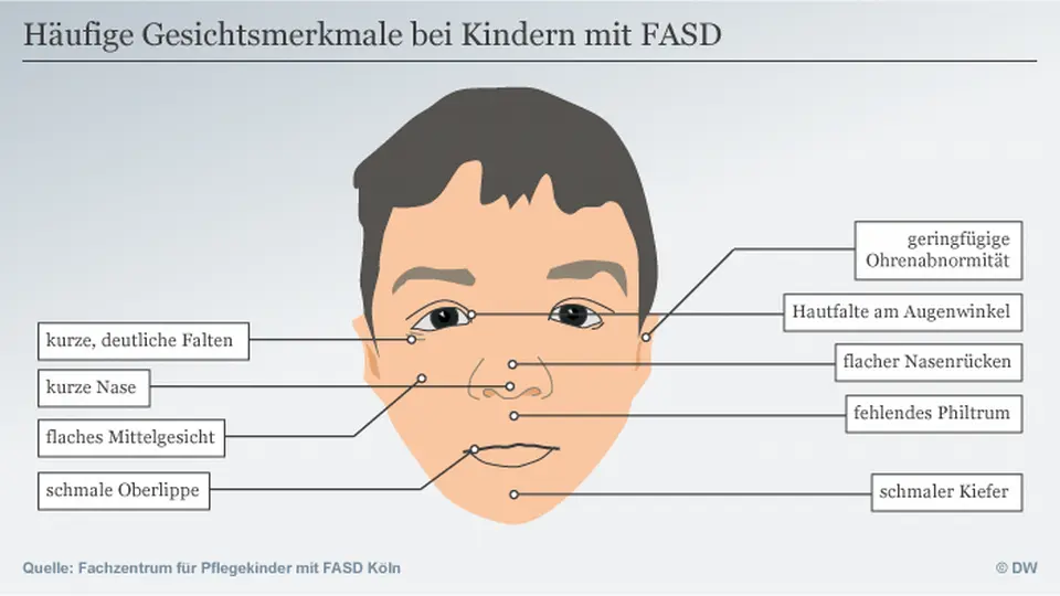alkohol schwangerschaft krankheit - Wie sehen Kinder mit FAS aus
