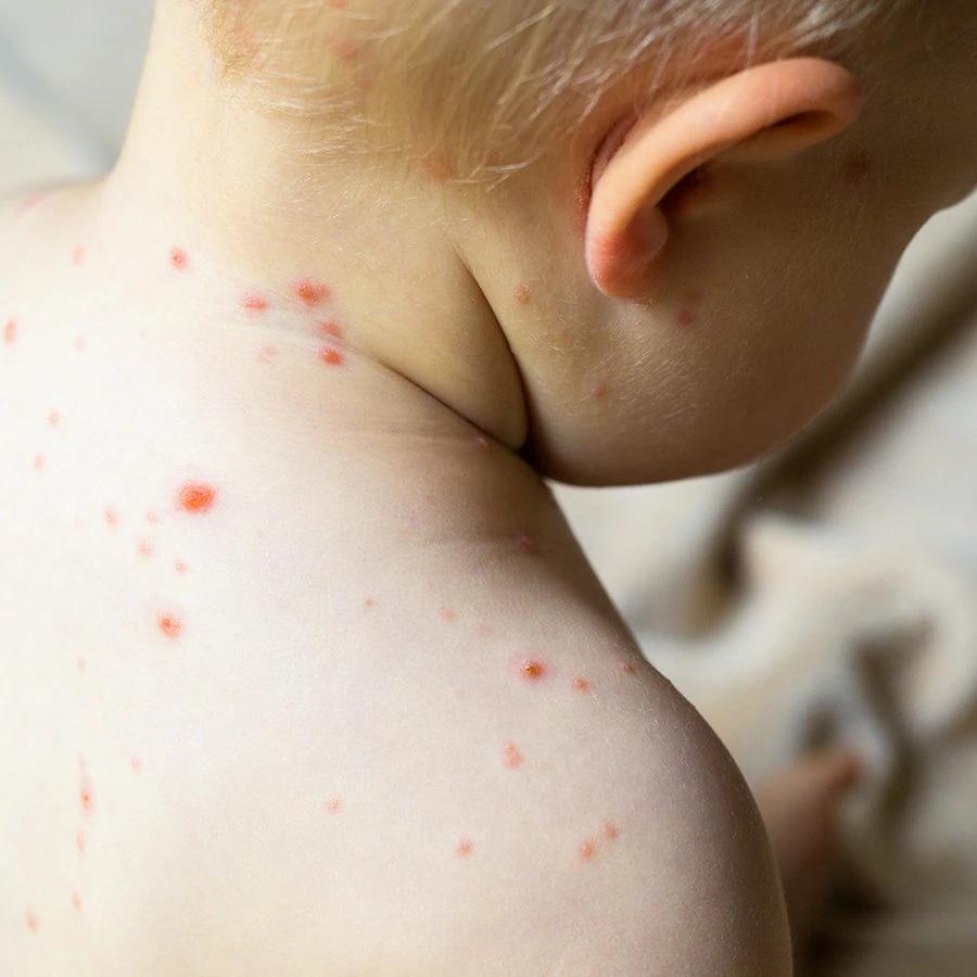 Pocken bei Kindern: Symptome, Behandlung und Vorbeugung - Wie sehen Pocken bei Kindern aus pocken bei kindern - Wie sehen Pocken bei Kindern aus
