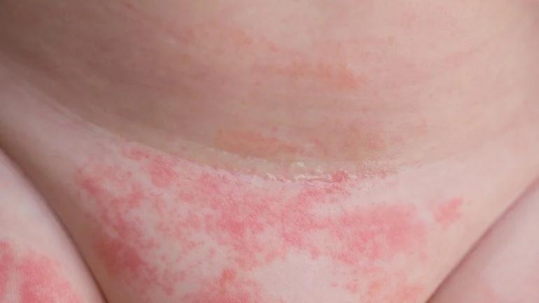 Ausschlag bei Kindern: Ursachen, Symptome und Behandlung - Wie sehen Scharlach Flecken aus ausschlag leiste kind - Wie sehen Scharlach Flecken aus