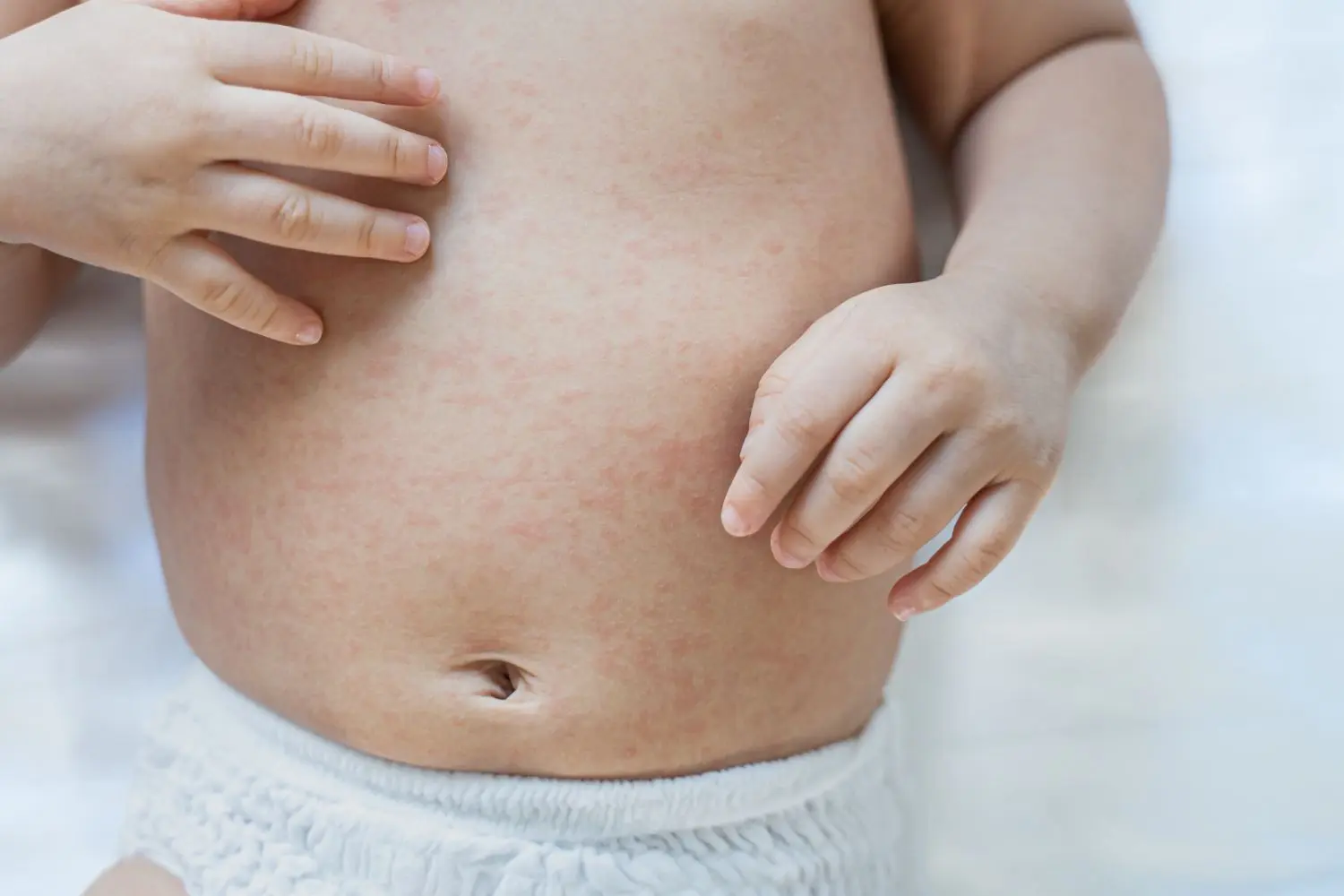 baby ausschlag bauch - Wie sieht Allergie Ausschlag aus Baby