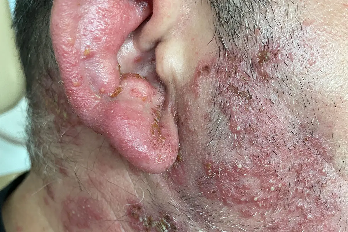 Ausschlag am Ohr Kind: Ursachen, Symptome und Behandlung - Wie sieht ein Ekzem am Ohr aus ausschlag am ohr kind - Wie sieht ein Ekzem am Ohr aus