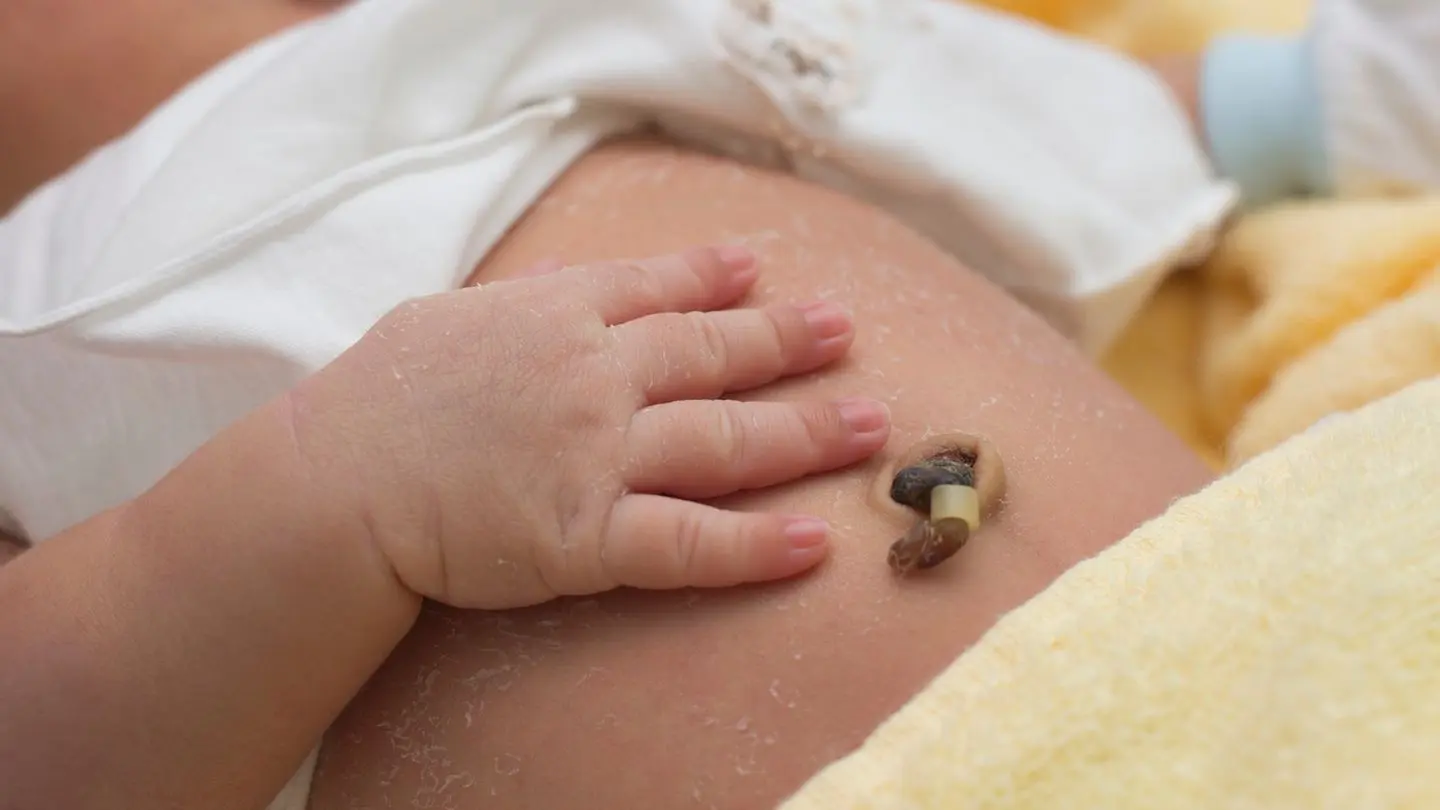 bauchnabel nach geburt braun - Wie sieht ein entzündeter Bauchnabel bei Babys aus
