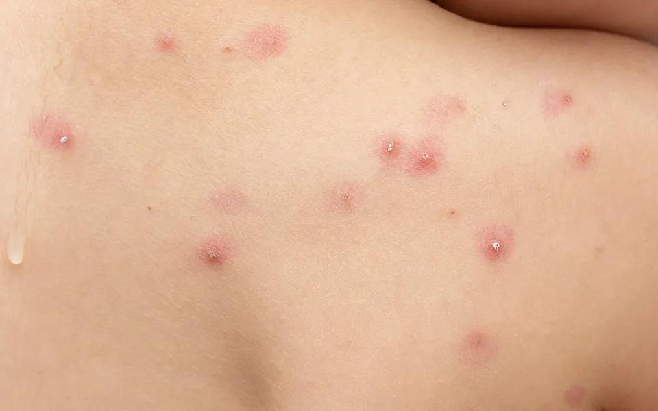 ausschlag bauch ohne juckreiz - Wie sieht ein Hautausschlag bei Stress aus