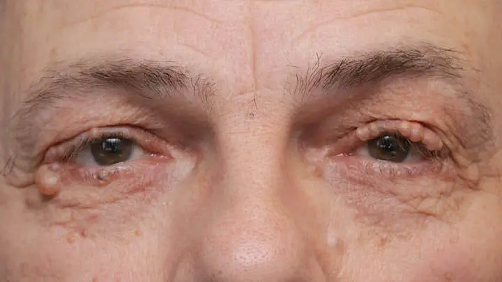 Warzen am Augenlid: Ursachen, Symptome und Behandlung - Wie sieht ein Papillom am Augenlid aus warze auf dem augenlid - Wie sieht ein Papillom am Augenlid aus