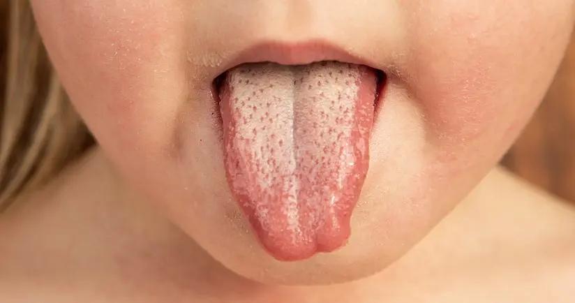 scharlach immer wieder - Wie sieht ein Scharlach Rückfall aus