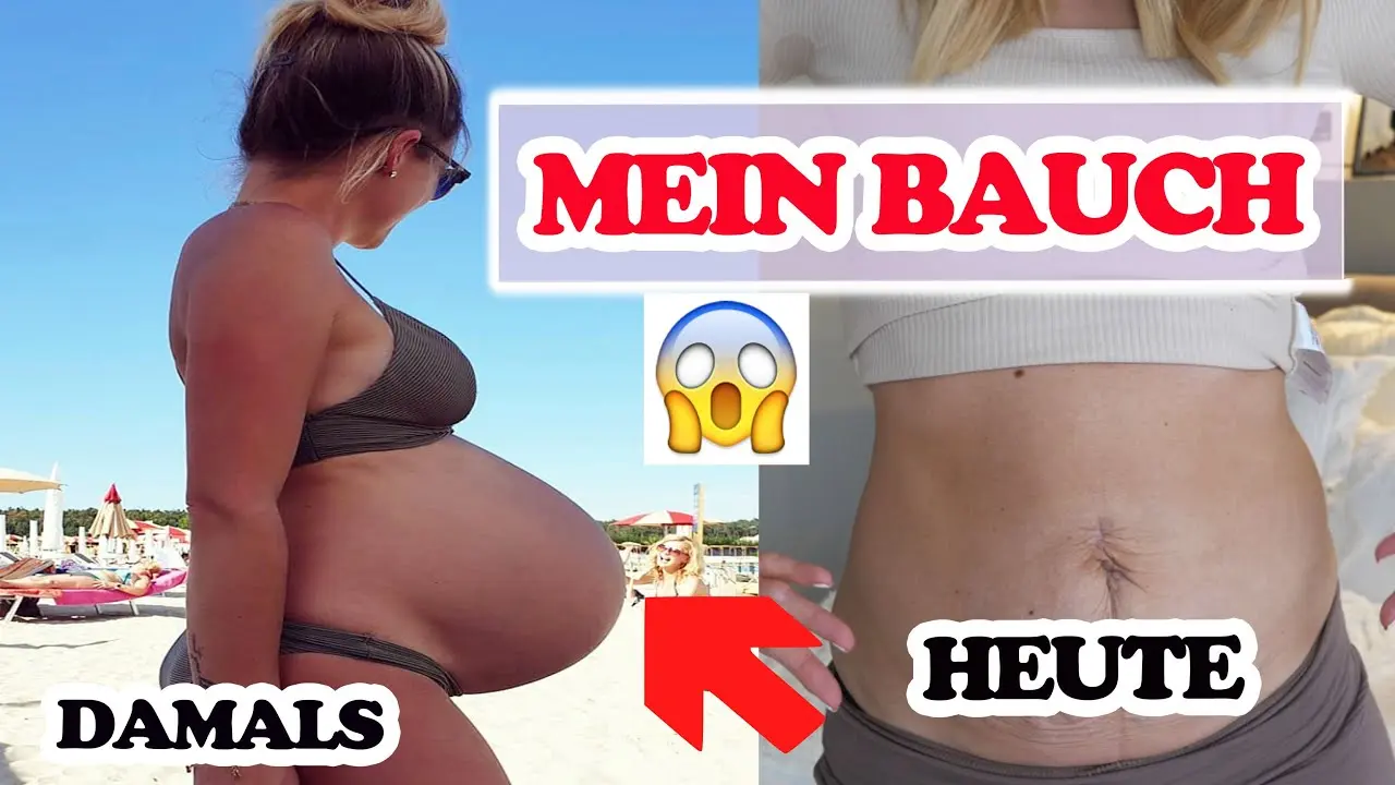 zwillinge bauch nach geburt - Wie sieht ein Zwillingsbauch aus