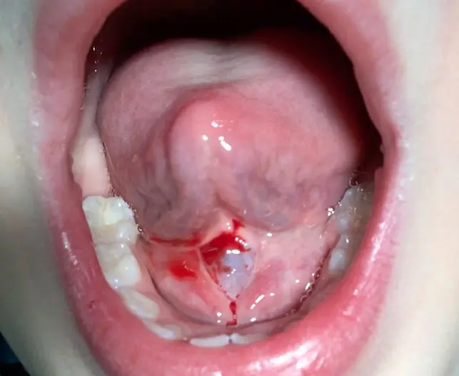 zungenbändchen entzündet was tun - Wie sieht eine Speicheldrüsenentzündung aus