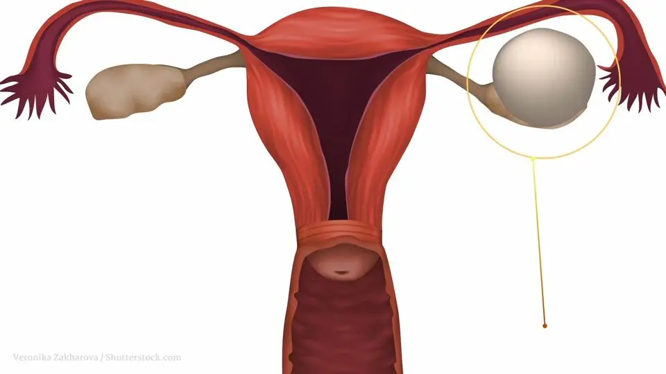 Geplatzte Zyste in der Gebärmutter: Ursachen, Symptome und Behandlung - Wie sieht es aus wenn eine Zyste abgeht geplatzte zyste gebärmutter - Wie sieht es aus wenn eine Zyste abgeht
