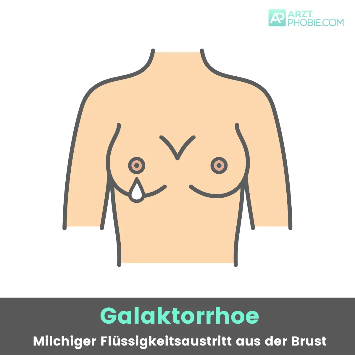 flüssigkeit aus brustwarze ohne schwangerschaft - Wie sieht Galaktorrhoe aus