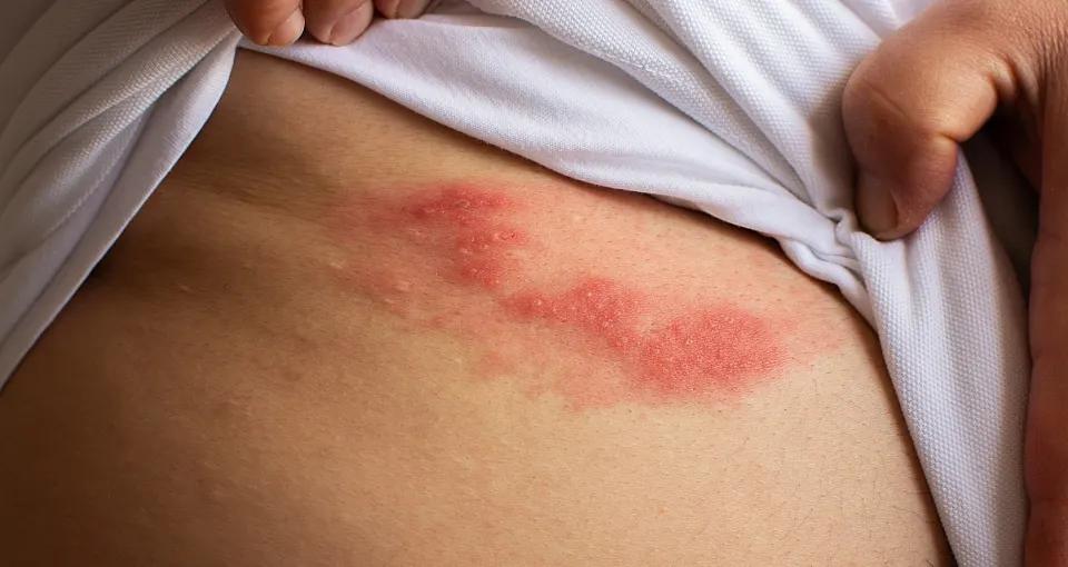 roter fleck an der brust - Wie sieht Hautausschlag bei Brustkrebs aus