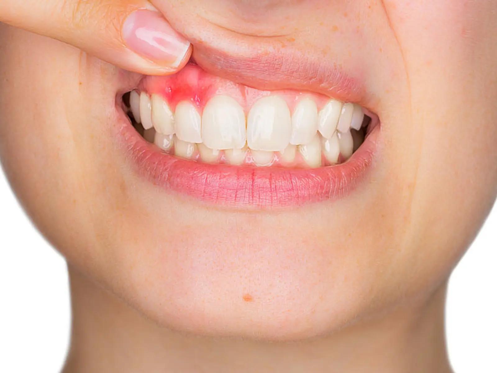 roter punkt zahnfleisch - Wie sieht Karies im Zahnfleisch aus