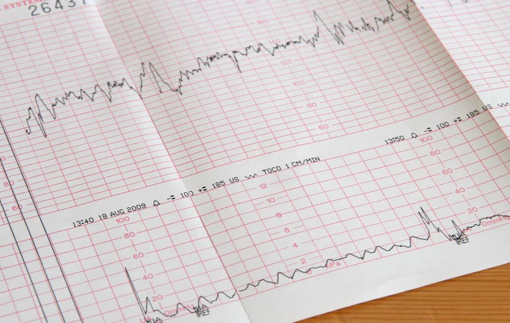 ctg wehen werte geburt - Wie sieht man die Wehen auf dem CTG